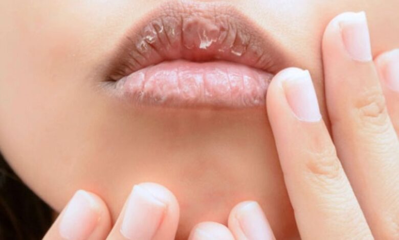 Cara alami atasi bibir kering juga juga pecah-pecah agar tampil percaya diri
